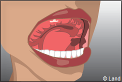 La prothese amovible