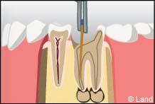 traitement radiculaire