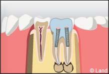 traitement radiculaire